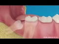 Surgical Tooth Extraction