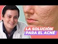 Cicatrices atróficas del acné - ¿Cómo tratarlas? - Clínica Vásquez Lapel