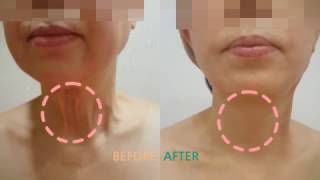 50대 후반 여성 목주름 리프팅 전, 후 (Women in their late 50s Before and after lifting neck wrinkles)