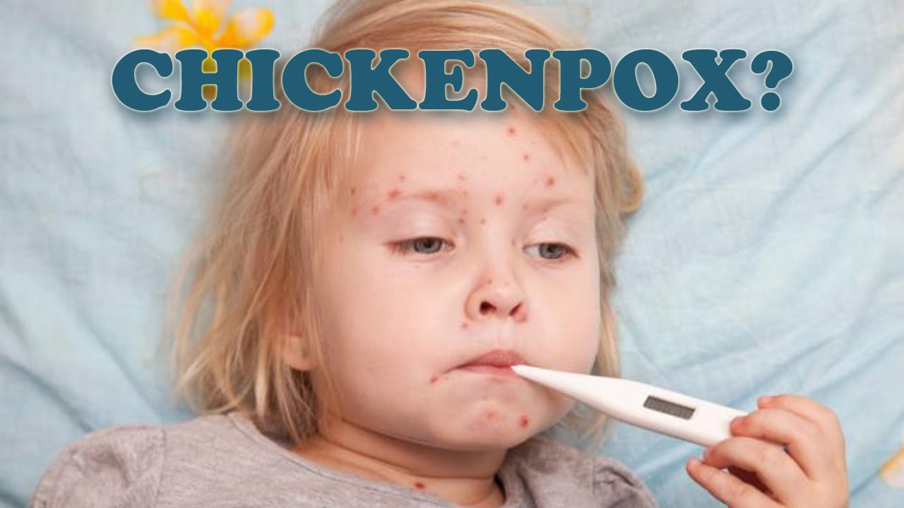 Chicken Pox Cure - How To Cure Chicken Pox Scar Fast - YouTube