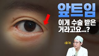 앞트임 수술 성공률을 높이는 방법  | 압구정김원장