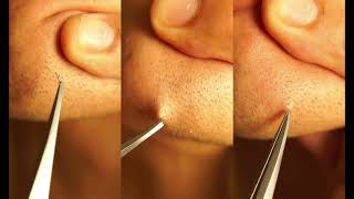 Super Satisfying Ingrown Hair Removal 1 pull out per min ALL time MIX 2022