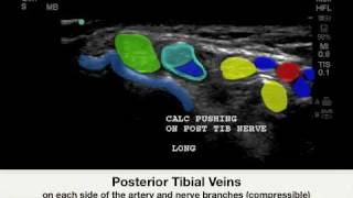 How To: Ankle - Tarsal Tunnel Case Study Video