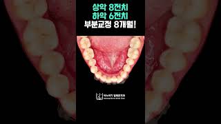 원하는 치아만 쏙!🦷 부분교정 8개월 변화 과정! #부분교정 #shorts