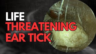 Life Threatening Ear TIck Infestation