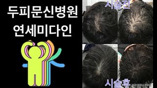 두피문신-프리미엄 도트(무바늘 레이저+기본 도트)