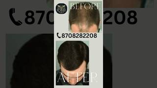 Hair Treatment Before \u0026 After |.          Dr. Grewal | 8708282208.   #shorts #viralvideo