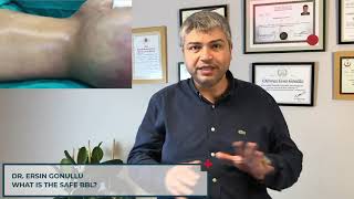 What is a SAFE BBL? | Aesthetic Surgery in Turkey - Safe BBL