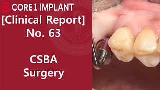 [CYBERMED Clinical Report] #16, 17, 47 Implant with CSBA surgery