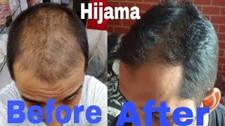 Hijama Treatment Stop Hair Fall By Hijama Treatment Grow New