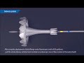 niti s™ gastrointestinal metal stent spaxus™ stent delivery system animation