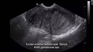 CASE 397 SUBSEROSAL FIBRIOD WITH PREGNANCY