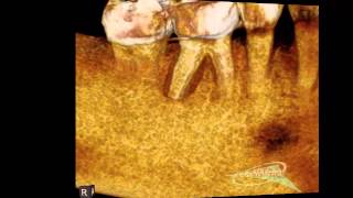 Buccal bone loss, suggestive of a fracture