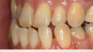 前歯で噛めない反対咬合を手術や抜歯をせずに治した矯正治療　Orthodontic treatment for opposite occlusion (no surgery)