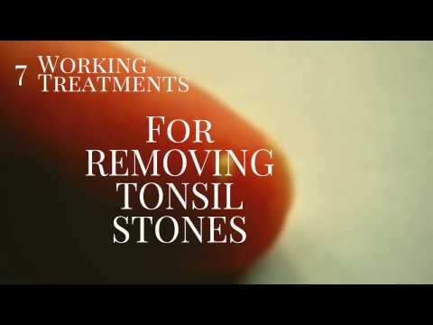 7 smashing treatments for Tonsil stone Removal 7 smashing treatments for Tonsil stone Removal