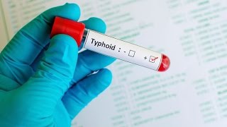 Typhoid Fever