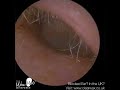 1 380 earache u0026 tinnitus due to complete ear wax blockage