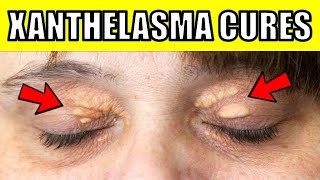 How to Get Rid of Cholesterol Deposits Under the Eyes Naturally (Xanthelasma Removal at Home)