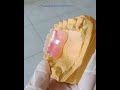 Valplast flexible denture