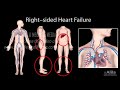 കൺജസ്റ്റീവ് ഹാർട്ട് പരാജയം ഇടതുവശം vs വലത് വശം സിസ്റ്റോളിക് vs ഡയസ്റ്റോളിക് ആനിമേഷൻ.
