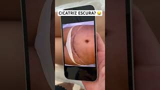 Tatuagem Clarear Cicatriz De Abdominoplastia | Antes e Depois #camuflagemdecicatriz