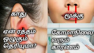 காது,மூக்கில் எதனால் ரத்தம் வருகிறது தெரியுமா? கோமாநிலை//How to bleeding nose and ear