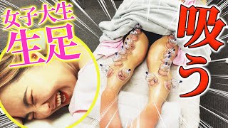 【吸い玉　瘀血】女子大生の腰が最悪瘀血、腰とふくらはぎがオッサン化　吸い玉でと鍼で腰バキバキの治療とふくはぎが痩せ　11円で自分で出来る方法も教えます【横浜　銀座　鍼灸】