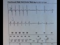 svt or vt