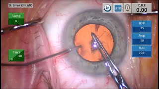 The Best Way To Do Cataract Surgery #14, Cannula Fixation, Cannula Flush