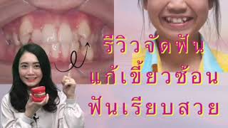 รีวิวจัดฟันแก้ฟันเขี้ยวซ้อนให้ฟันเรียบสวย/dental point pattaya /โดยหมอหลิน