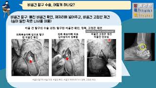 {발톡!}, 종골 골절과 동반된 비골건 탈구.