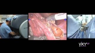 Robotic hysterectomy with VIKY UP