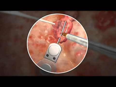 Animation: Revision Cochlear Implant - YouTube