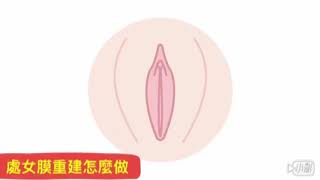 54歲竟處女膜整型