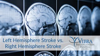Left Hemisphere Stroke vs. Right Hemisphere Stroke | Vibra Rehabilitation Hospital of Amarillo