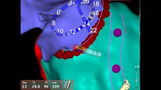 ABL4 at Pinellas Arrhythmia Associates P.A.