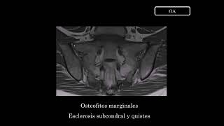 Radiología en 5 minutos: Osteoartritis.