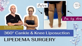 360° CANKLE \u0026 KNEE LIPEDEMA LIPOSUCTION | Artlipo | Expert  Dr. Kardashian