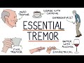 Understanding Benign Essential Tremor