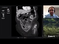 Isolation tutorial: Abdominal CT #2 with Vikas Shah