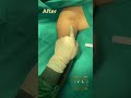 transform your arms with scarless arm lift by dr. tas expert insights