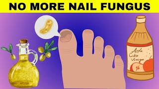 😱🌿 Say Goodbye to Fungal Infections TODAY! | Nail Fungus