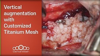 Vertical augmentation with Customized Titanium Mesh - [Dr. Kim Yongjin]