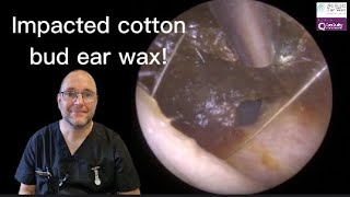 Impacted cotton bud ear wax - Episode 43