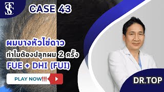 ผมบางหัวล้านไข่ดาว รักษาโดยการปลูกผม 2 ครั้ง เทคนิค FUE+DHI (FUI)