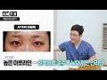 어색한 소세지눈🌭비절개 라인낮추기 두줄따기 로 개선할 수 있나요 ㅣ가능한 경우 영상에서 확인✅