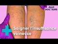 Jambes lourdes, varices... il existe des solutions - Allo Docteurs