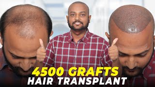 Hair Transplant in Bhubaneswar | Best Results \u0026 Cost of Hair Transplant in Bhubaneswar