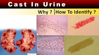 Cast in Urine  ( Why \u0026 How to Identify ? )