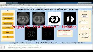 Lung Nodule Detection On Dicom Image Using Neural Network | With Source Code | Matlab Project Code